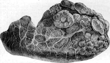 Emphysema: figure 2 from the 1928–1936 encyclopedia article