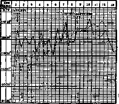 Endocarditis: figure 5 from the 1928–1936 encyclopedia article