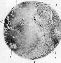 Endocarditis: figure 3 from the 1928–1936 encyclopedia article