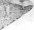 Endocarditis: figure 1 from the 1928–1936 encyclopedia article