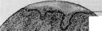 Acute Rheumatism: figure 5 from the 1928–1936 encyclopedia article