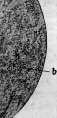 Acute Rheumatism: figure 7 from the 1928–1936 encyclopedia article