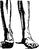 Synkinesias: figure 3 from the 1928–1936 encyclopedia article