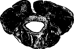 Syringomyelia: figure 1 from the 1928–1936 encyclopedia article