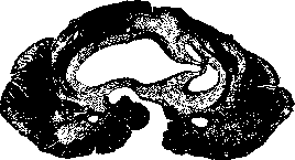 Syringomyelia: figure 2 from the 1928–1936 encyclopedia article
