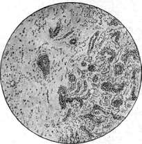 Syphilis: figure 9 from the 1928–1936 encyclopedia article