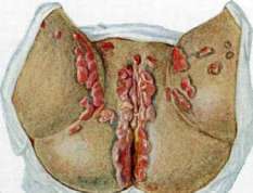 Syphilis: figure 3 from the 1928–1936 encyclopedia article