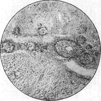 Syphilis: figure 8 from the 1928–1936 encyclopedia article