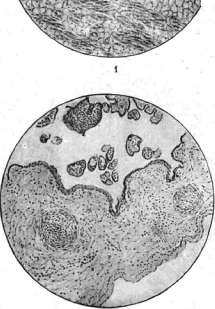 Syphilis: figure 6 from the 1928–1936 encyclopedia article