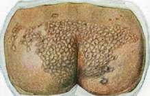 Syphilis: figure 4 from the 1928–1936 encyclopedia article
