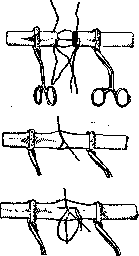 Vascular Suture: figure 1 from the 1928–1936 encyclopedia article