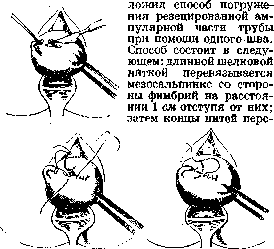 Sexual Sterilization: figure 32 from the 1928–1936 encyclopedia article