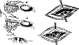 Sexual Sterilization: figure 35 from the 1928–1936 encyclopedia article