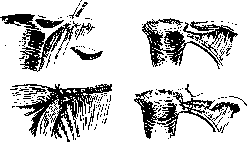 Sexual Sterilization: figure 31 from the 1928–1936 encyclopedia article