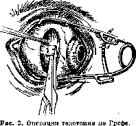 Tenotomy: figure 2 from the 1928–1936 encyclopedia article