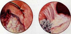 Thoracoplasty: figure 25 from the 1928–1936 encyclopedia article
