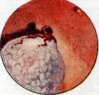 Thoracoplasty: figure 22 from the 1928–1936 encyclopedia article
