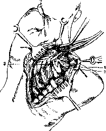 Thoracoplasty: figure 9 from the 1928–1936 encyclopedia article