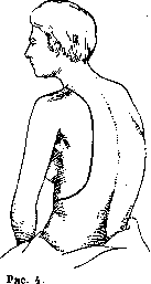 Thoracoplasty: figure 8 from the 1928–1936 encyclopedia article