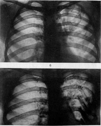 Thoracoplasty: figure 5 from the 1928–1936 encyclopedia article