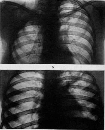Thoracoplasty: figure 4 from the 1928–1936 encyclopedia article