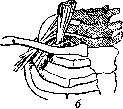 Thoracoplasty: figure 18 from the 1928–1936 encyclopedia article