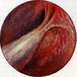 Thoracoplasty: figure 23 from the 1928–1936 encyclopedia article