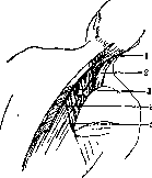 Thoracoplasty: figure 11 from the 1928–1936 encyclopedia article