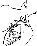 Thoracoplasty: figure 10 from the 1928–1936 encyclopedia article