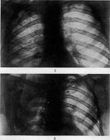 Thoracoplasty: figure 2 from the 1928–1936 encyclopedia article
