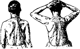 Thoracoplasty: figure 26 from the 1928–1936 encyclopedia article