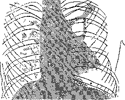 Thoracoscopy: figure 4 from the 1928–1936 encyclopedia article