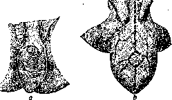 Phimosis: figure 1 from the 1928–1936 encyclopedia article