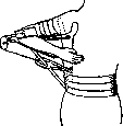 Splints: figure 25 from the 1928–1936 encyclopedia article