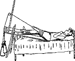 Splints: figure 17 from the 1928–1936 encyclopedia article