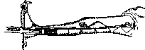 Splints: figure 20 from the 1928–1936 encyclopedia article