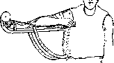 Splints: figure 27 from the 1928–1936 encyclopedia article