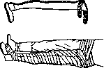 Splints: figure 14 from the 1928–1936 encyclopedia article