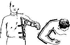 Splints: figure 24 from the 1928–1936 encyclopedia article