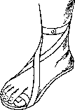 Hallux Valgus: figure 5 from the 1928–1936 encyclopedia article