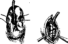 Jejunostomy: figure 1 from the 1928–1936 encyclopedia article