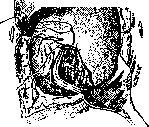 Cesarean Section: figure 6 from the 1928–1936 encyclopedia article