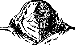 Cesarean Section: figure 1 from the 1928–1936 encyclopedia article