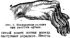Paralysis Agitans: figure 2 from the 1928–1936 encyclopedia article