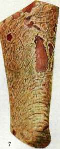 Pemphigus: figure 6 from the 1928–1936 encyclopedia article