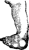 Varus: figure 3 from the 1928–1936 encyclopedia article