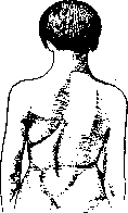 Scoliosis: figure 1 from the 1928–1936 encyclopedia article