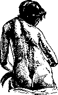 Scoliosis: figure 2 from the 1928–1936 encyclopedia article