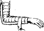 Plaster Casts, Corsets, and Beds: figure 1 from the 1928–1936 encyclopedia article