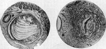 Thrombus: figure 5 from the 1928–1936 encyclopedia article